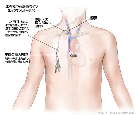 カテーテル 中心 静脈