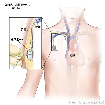 カテーテル 中心 静脈