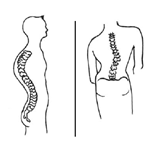 脊柱側弯症と脊柱後弯症の図